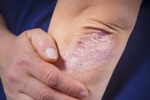 Ефективність лікування шкірних захворювань (псоріаз, атопічний дерматит) кремом «Карталін»
